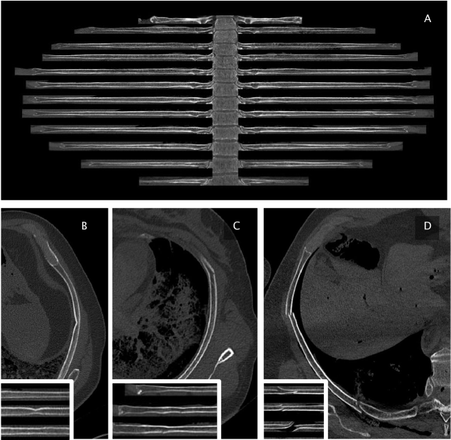 Automated Rib Fracture Detection Of Postmortem Computed